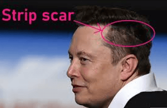 Elon Musk Scar